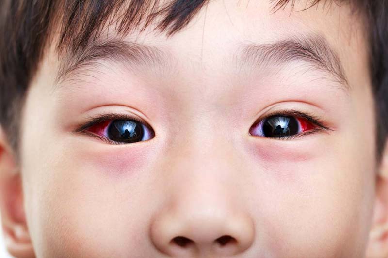 Conjunctivitis in a child.