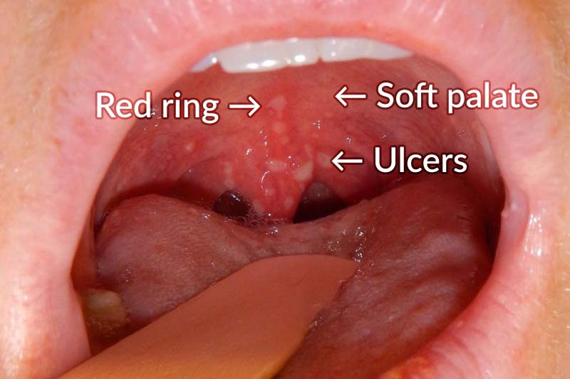HFMD ulcers in mouth.