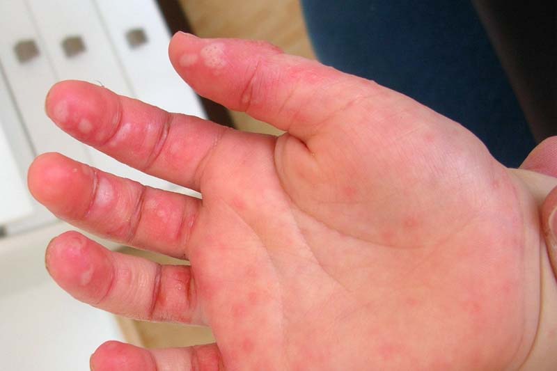 HFMD hand blisters.