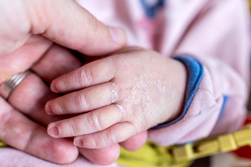 7 Punca Kulit Bayi Kering (Merangkumi Rawatan) | Ethissa